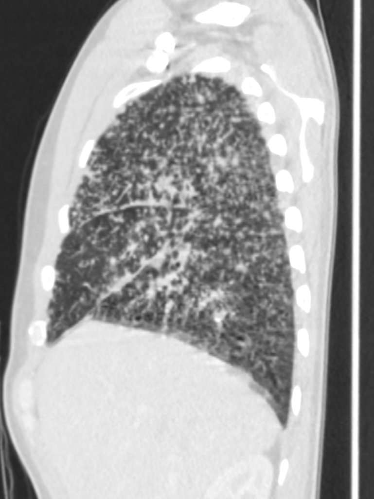 Sarcoidosis Lung Ct Scan