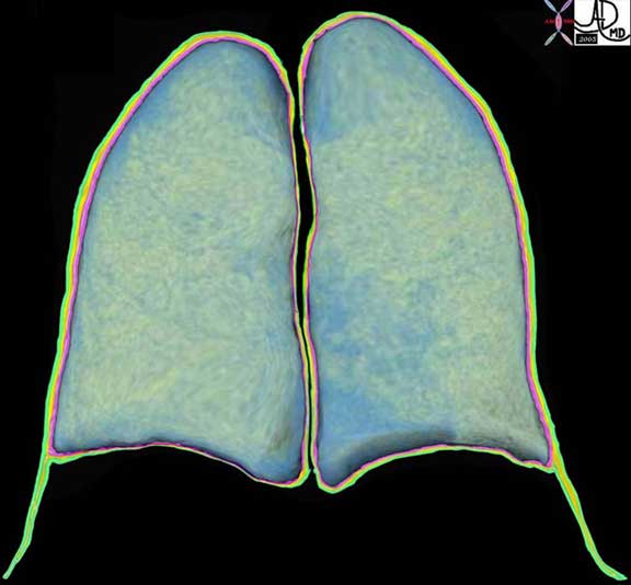 Split Pleura Sign | Lungs