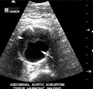 Aorta | Applied Anatomy