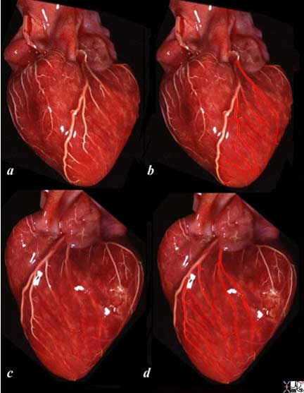 Coronary Arteries Applied Anatomy