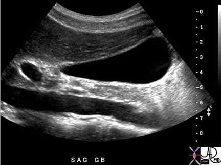 Gallbladder | Applied Anatomy