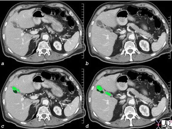 Gallbladder | Applied Anatomy