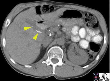 Gallbladder | Applied Anatomy