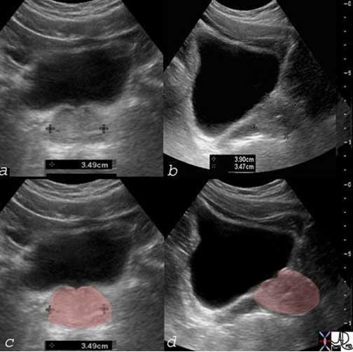 Prostate Applied Anatomy